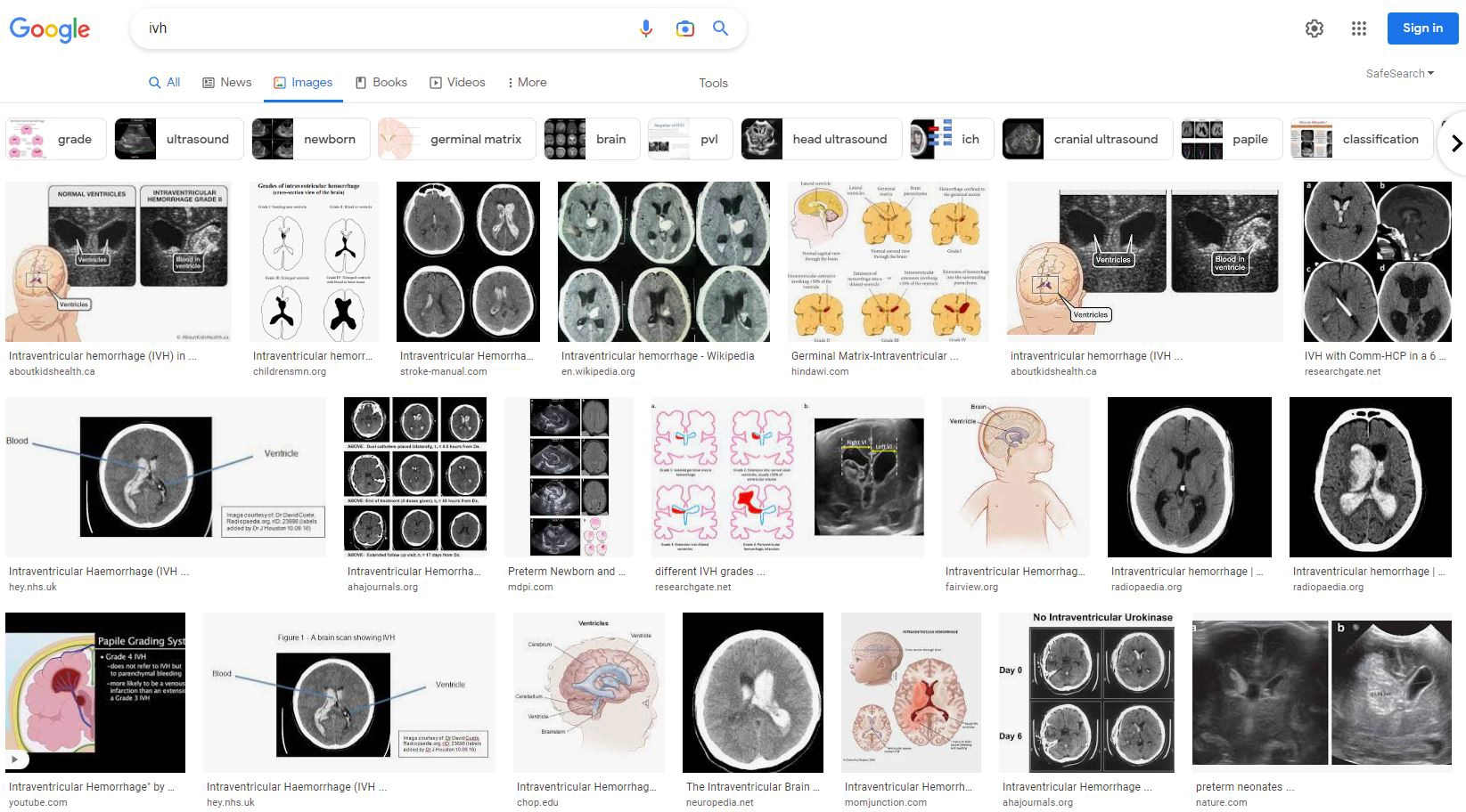 Screen capture of a Google image search on &ldquo;IVH&rdquo;