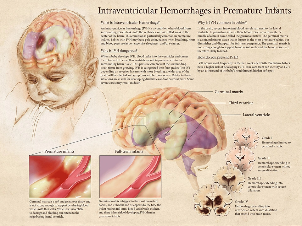 Intraventricular Hemorrhages in Premature Infants